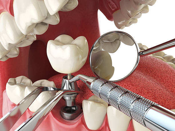 Best Emergency Dentist for Knocked-Out Tooth in Boulevard Park, WA
